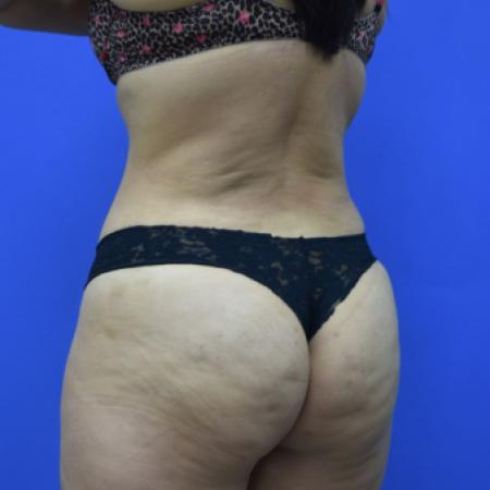 After image 4 Case #109506 - Drainless Tummy Tuck