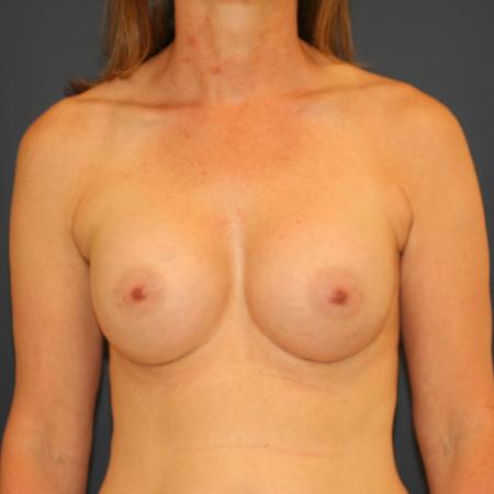 After image 1 Case #109536 - Breast Augmentation