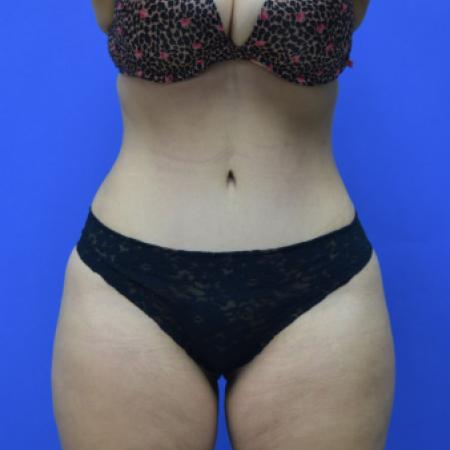 After image 1 Case #109506 - Drainless Tummy Tuck