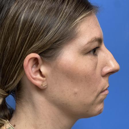 Before image 3 Case #109691 - 35 year old  -  Open Rhinoplasty  - 3 months post