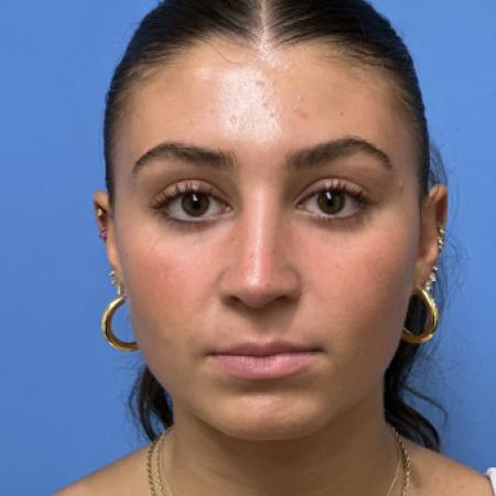 After image 1 Case #109686 - 17 year old  -  Open Rhinoplasty  -  3 months post