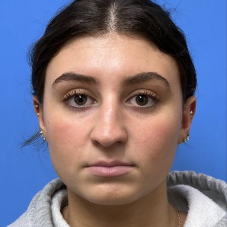 Before image 1 Case #109686 - 17 year old  -  Open Rhinoplasty  -  3 months post