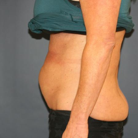 Before image 3 Case #109651 - Tummy Tuck (Abdominoplasty)