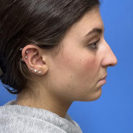 Before image 3 Case #109686 - 17 year old  -  Open Rhinoplasty  -  3 months post