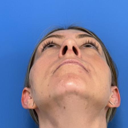 After image 4 Case #109691 - 35 year old  -  Open Rhinoplasty  - 3 months post