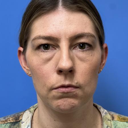 Before image 1 Case #109691 - 35 year old  -  Open Rhinoplasty  - 3 months post