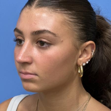 After image 2 Case #109686 - 17 year old  -  Open Rhinoplasty  -  3 months post