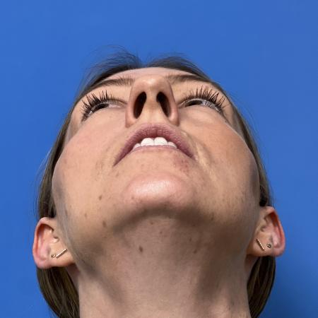 Before image 4 Case #109691 - 35 year old  -  Open Rhinoplasty  - 3 months post