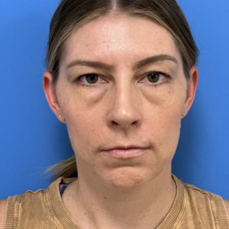After image 1 Case #109691 - 35 year old  -  Open Rhinoplasty  - 3 months post