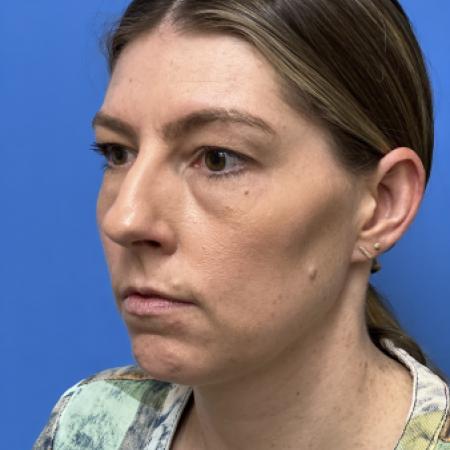 Before image 2 Case #109691 - 35 year old  -  Open Rhinoplasty  - 3 months post