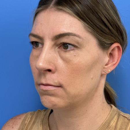 After image 2 Case #109691 - 35 year old  -  Open Rhinoplasty  - 3 months post