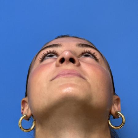 After image 4 Case #109686 - 17 year old  -  Open Rhinoplasty  -  3 months post