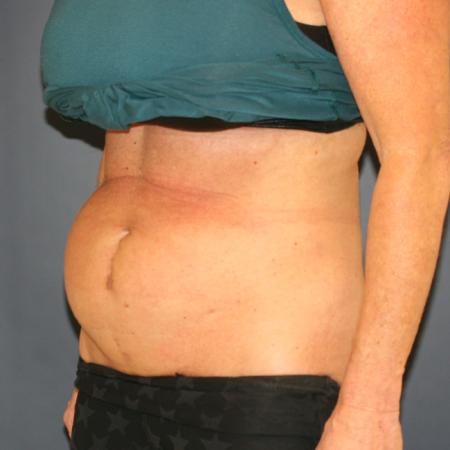 Before image 2 Case #109651 - Tummy Tuck (Abdominoplasty)