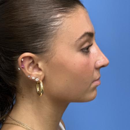 After image 3 Case #109686 - 17 year old  -  Open Rhinoplasty  -  3 months post