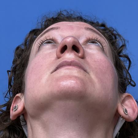 Before image 4 Case #109801 - 36 year old  -  Open Septo-Rhinoplasty 