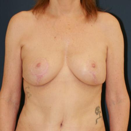 After image 1 Case #109891 - Lollipop Breast Lift (Circumvertical Mastopexy)