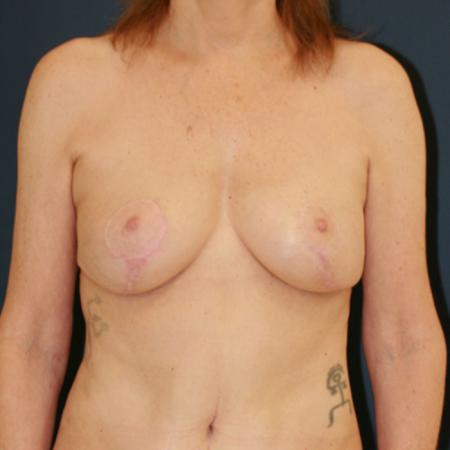 After image 1 Case #109891 - Lollipop Breast Lift (Circumvertical Mastopexy)