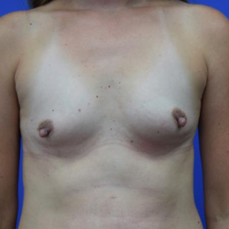 Before image 1 Case #109781 - Silicone Breast Augmentation