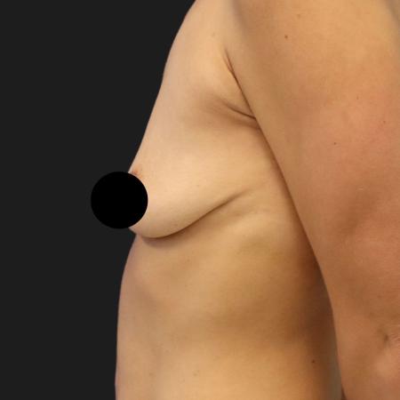 Before image 4 Case #109846 - 44 year-old breast augmentation and lift