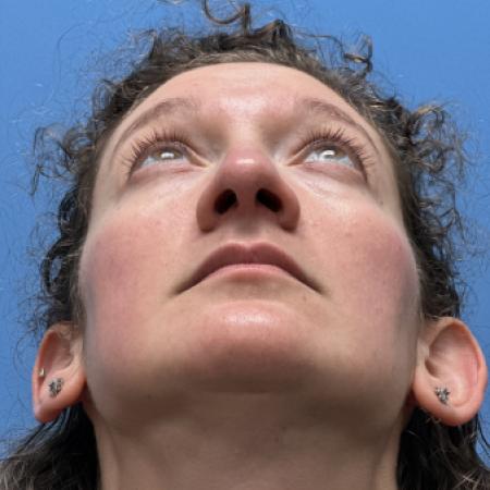 After image 4 Case #109801 - 36 year old  -  Open Septo-Rhinoplasty 