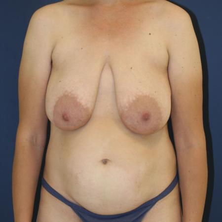 Before image 1 Case #109896 - Mommy Makeover