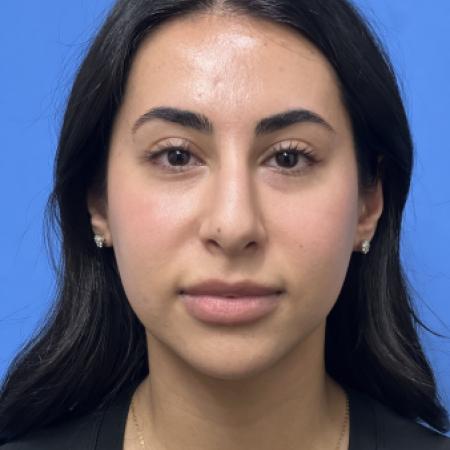 Before image 1 Case #109886 - 24 year old - Open Rhinoplasty- 6 months post-op