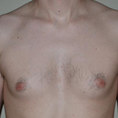 Before image 1 Case #109976 - Gynecomastia  Surgery