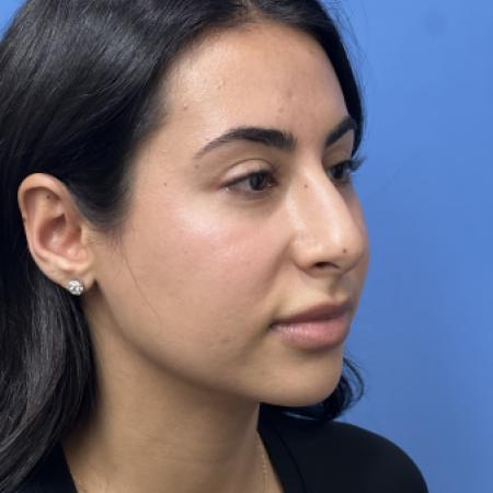Before image 2 Case #109886 - 24 year old - Open Rhinoplasty- 6 months post-op