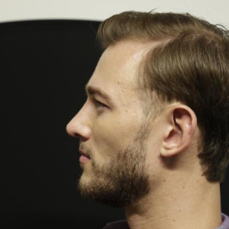 After image 3 Case #106486 - Male Face Transformation