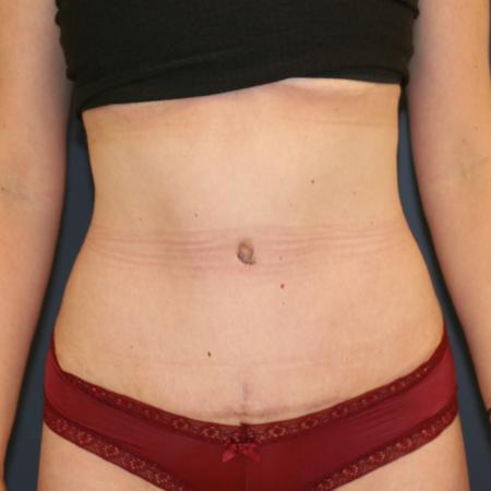 After image 1 Case #109951 - Tummy Tuck (Abdominoplasty)