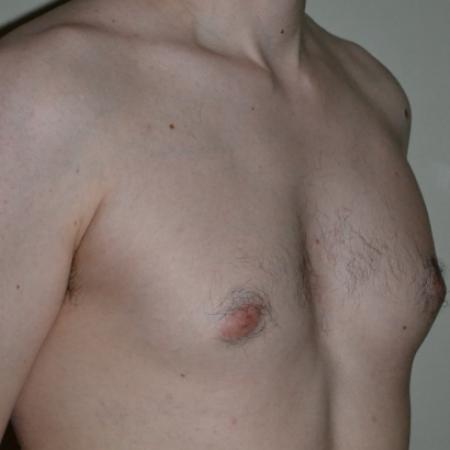 Before image 2 Case #109976 - Gynecomastia  Surgery