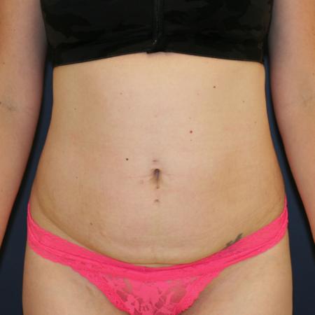 Before image 1 Case #109951 - Tummy Tuck (Abdominoplasty)
