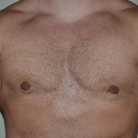 After image 1 Case #109991 - Gynecomastia and VASER liposuction of chest