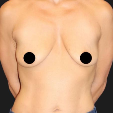 Before Case #109846 - 44 year-old breast augmentation and lift