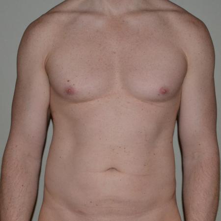 Before image 1 Case #109981 - VASER Hi Def Lipo