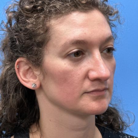 After image 2 Case #109801 - 36 year old  -  Open Septo-Rhinoplasty 