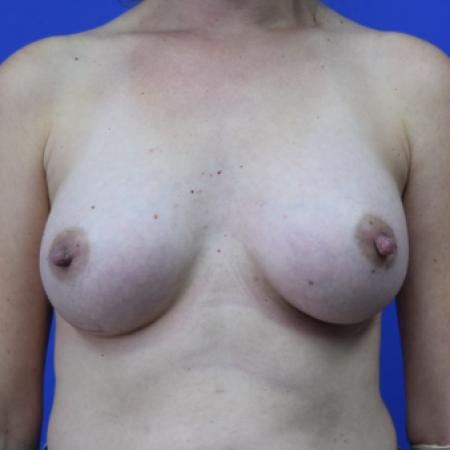 After image 1 Case #109781 - Silicone Breast Augmentation