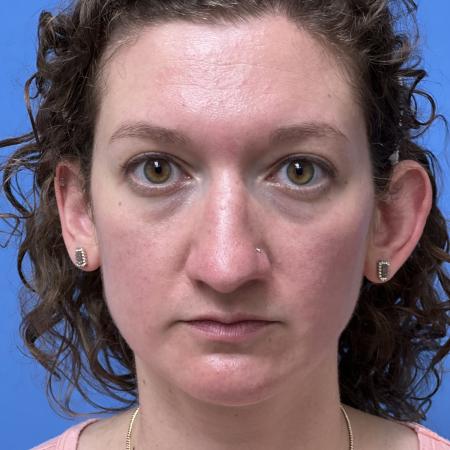 Before image 1 Case #109801 - 36 year old  -  Open Septo-Rhinoplasty 
