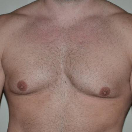 Before image 1 Case #109991 - Gynecomastia and VASER liposuction of chest