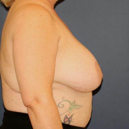 Before image 3 Case #109906 - Lollipop Breast Lift + Implant Exchange