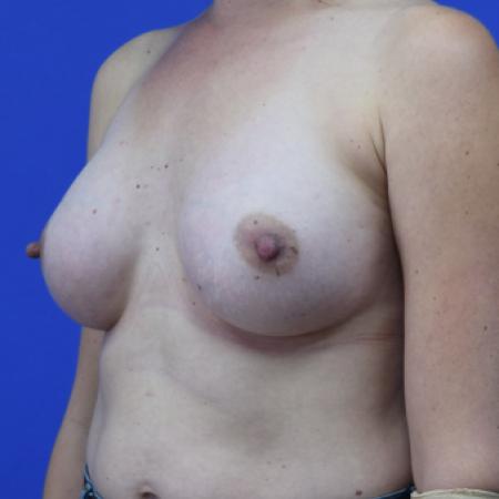 After image 2 Case #109781 - Silicone Breast Augmentation