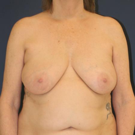 Before image 1 Case #109891 - Lollipop Breast Lift (Circumvertical Mastopexy)