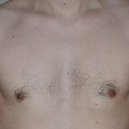 After image 1 Case #109976 - Gynecomastia  Surgery