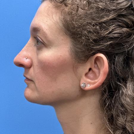 After image 3 Case #109801 - 36 year old  -  Open Septo-Rhinoplasty 
