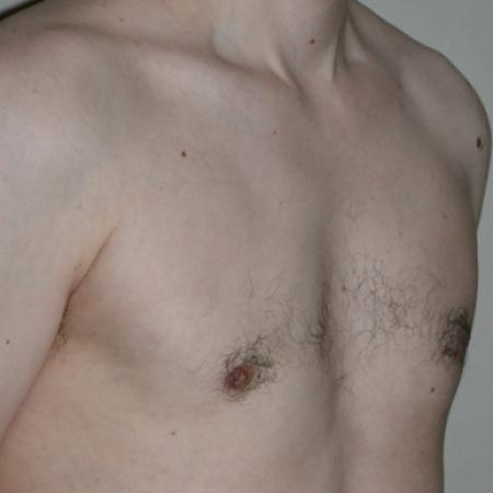 After image 2 Case #109976 - Gynecomastia  Surgery