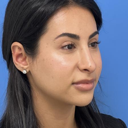 After image 2 Case #109886 - 24 year old - Open Rhinoplasty- 6 months post-op