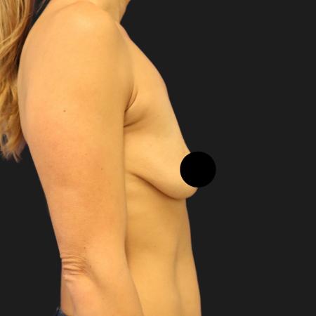 Before image 3 Case #109846 - 44 year-old breast augmentation and lift