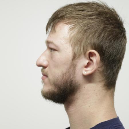 Before image 3 Case #106486 - Male Face Transformation