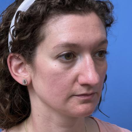 Before image 2 Case #109801 - 36 year old  -  Open Septo-Rhinoplasty 