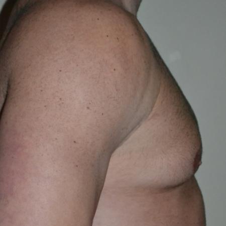 Before image 3 Case #109991 - Gynecomastia and VASER liposuction of chest